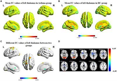 Functional connectivity alterations in the thalamus among patients with bronchial asthma